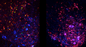 ALS disease under microscope